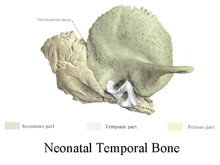Neonatal Temporal Bone 