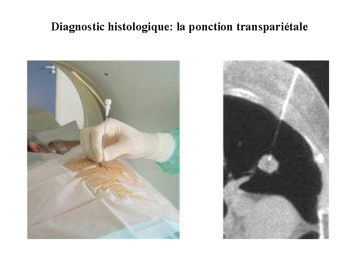 Diagnostic histologique: la ponction transpariétale 