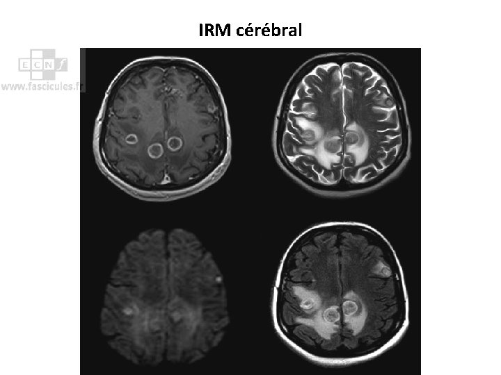IRM cérébral 