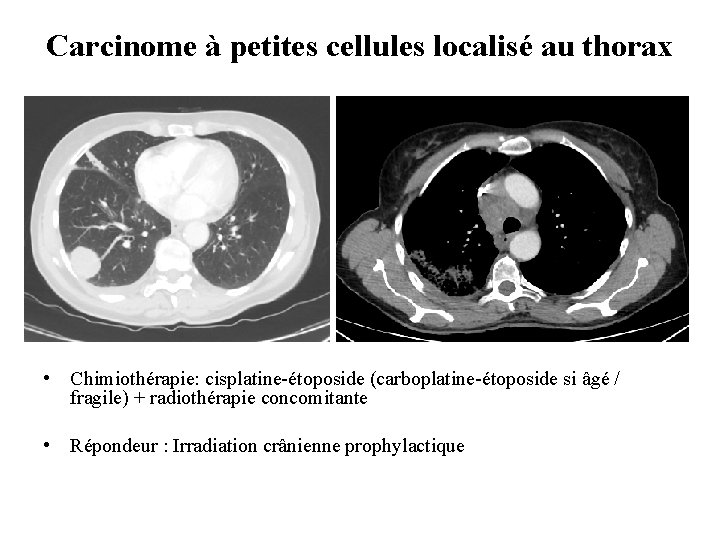 Carcinome à petites cellules localisé au thorax • Chimiothérapie: cisplatine-étoposide (carboplatine-étoposide si âgé /