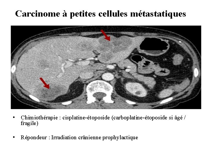 Carcinome à petites cellules métastatiques • Chimiothérapie : cisplatine-étoposide (carboplatine-étoposide si âgé / fragile)