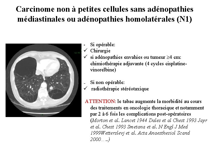 Carcinome non à petites cellules sans adénopathies médiastinales ou adénopathies homolatérales (N 1) -