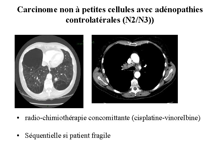 Carcinome non à petites cellules avec adénopathies controlatérales (N 2/N 3)) • radio-chimiothérapie concomittante