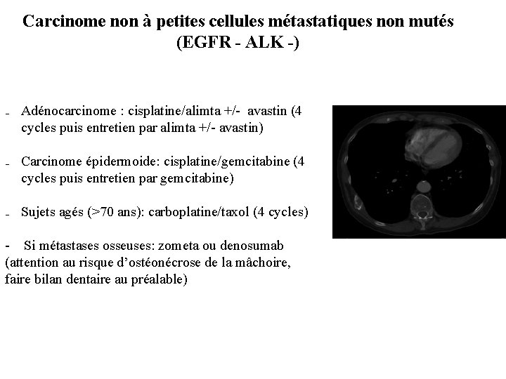 Carcinome non à petites cellules métastatiques non mutés (EGFR - ALK -) ₋ Adénocarcinome