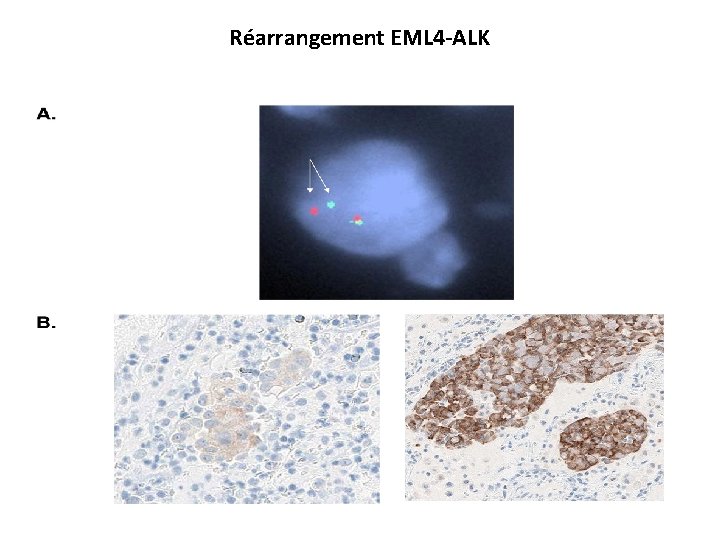 Réarrangement EML 4 -ALK 