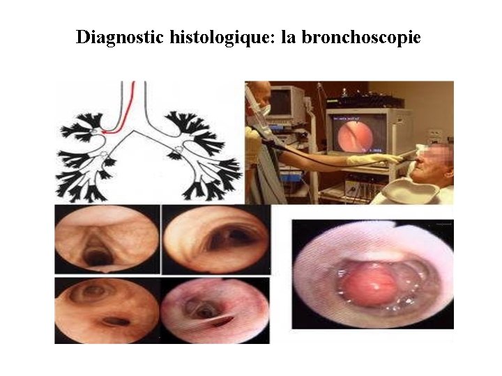 Diagnostic histologique: la bronchoscopie 