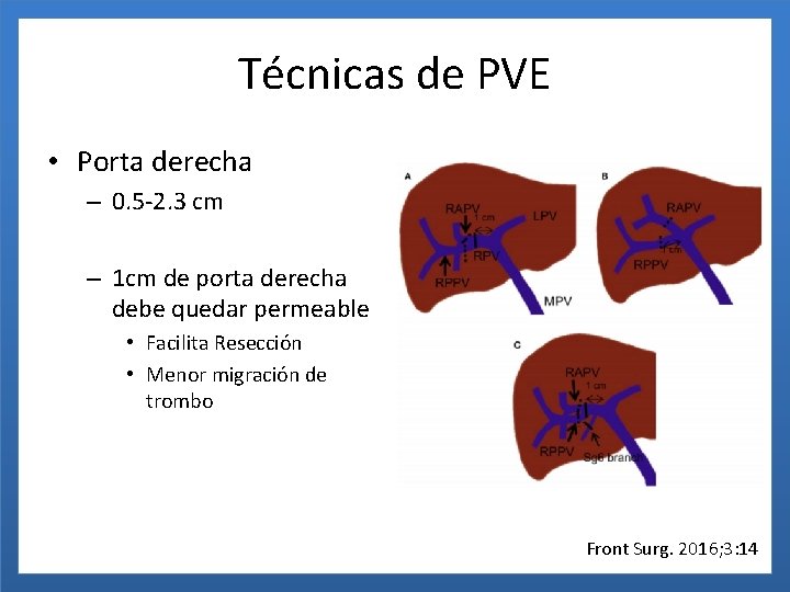 Técnicas de PVE • Porta derecha – 0. 5 -2. 3 cm – 1
