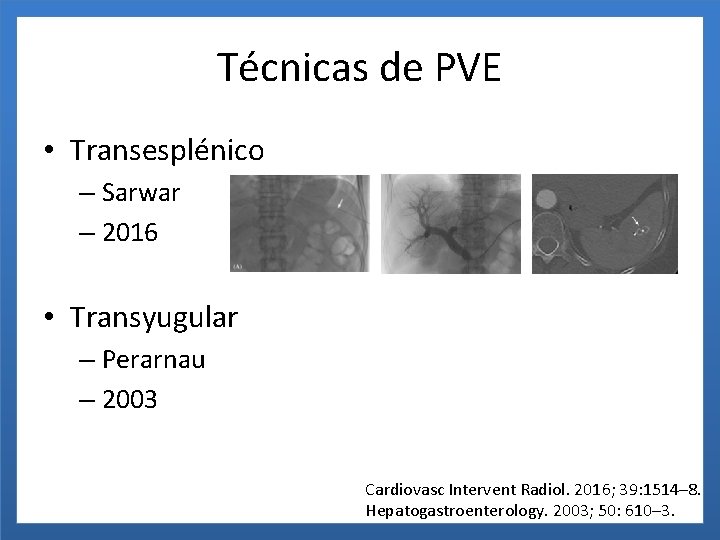 Técnicas de PVE • Transesplénico – Sarwar – 2016 • Transyugular – Perarnau –