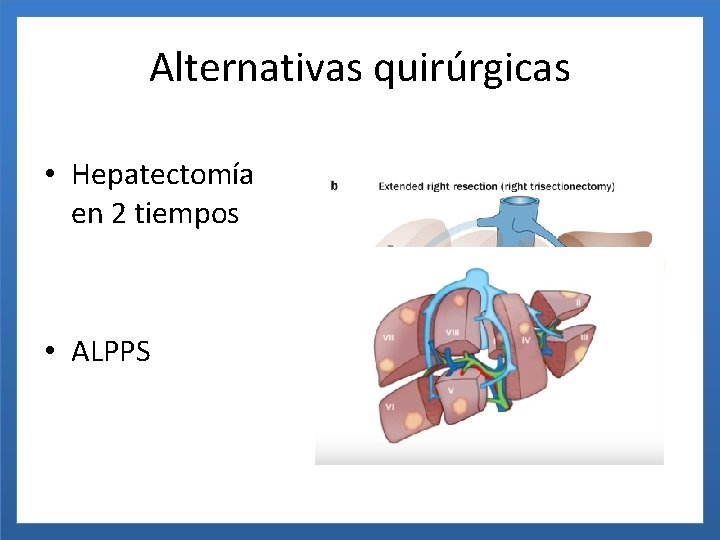 Alternativas quirúrgicas • Hepatectomía en 2 tiempos • ALPPS 