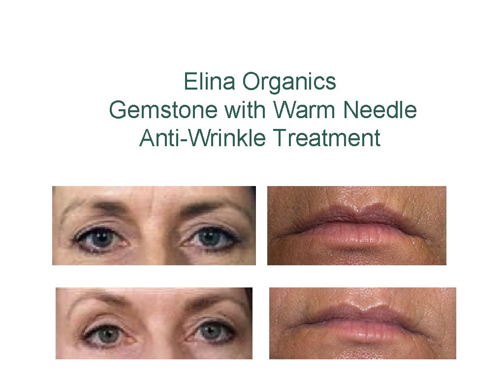 Elina Organics Gemstone with Warm Needle Anti-Wrinkle Treatment 
