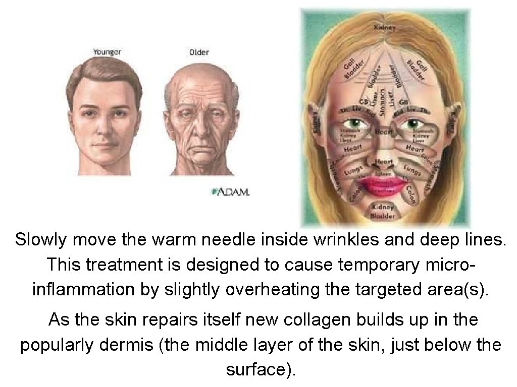 Slowly move the warm needle inside wrinkles and deep lines. This treatment is designed