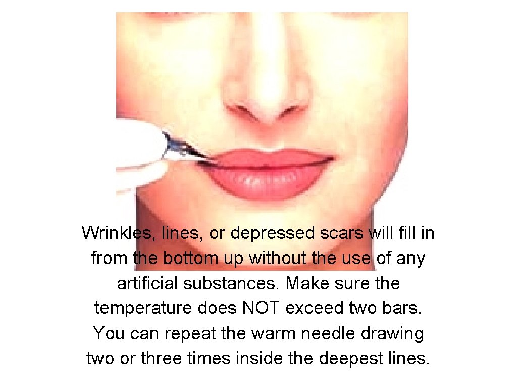 Wrinkles, lines, or depressed scars will fill in from the bottom up without the