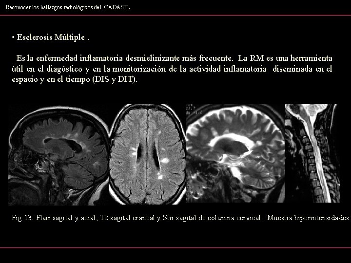 Reconocer los hallazgos radiológicos del CADASIL. • Esclerosis Múltiple. Es la enfermedad inflamatoria desmielinizante