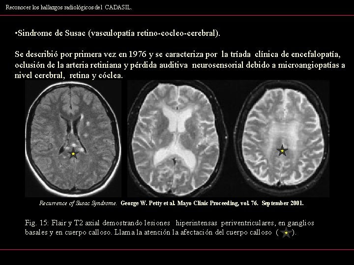 Reconocer los hallazgos radiológicos del CADASIL. • Sindrome de Susac (vasculopatía retino-cocleo-cerebral). Se describió