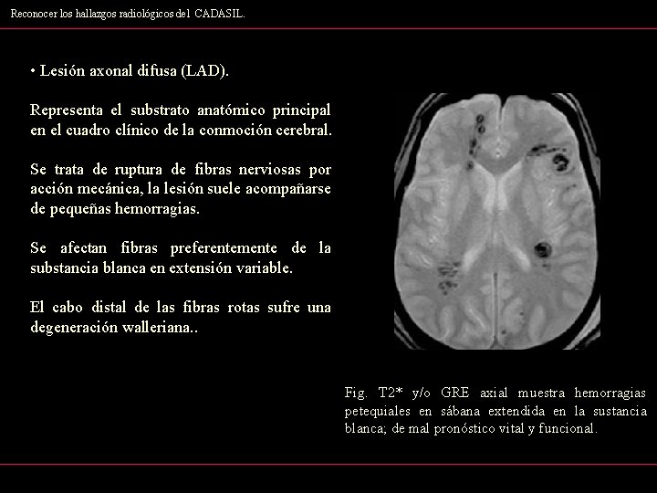 Reconocer los hallazgos radiológicos del CADASIL. • Lesión axonal difusa (LAD). Representa el substrato