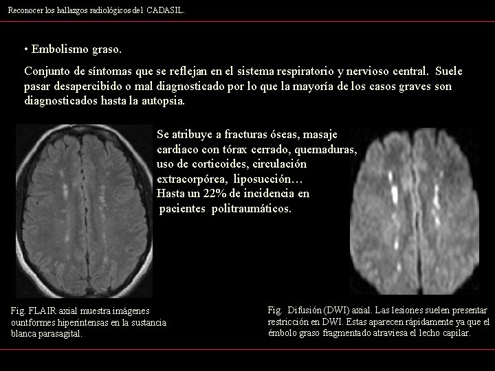 Reconocer los hallazgos radiológicos del CADASIL. • Embolismo graso. Conjunto de síntomas que se