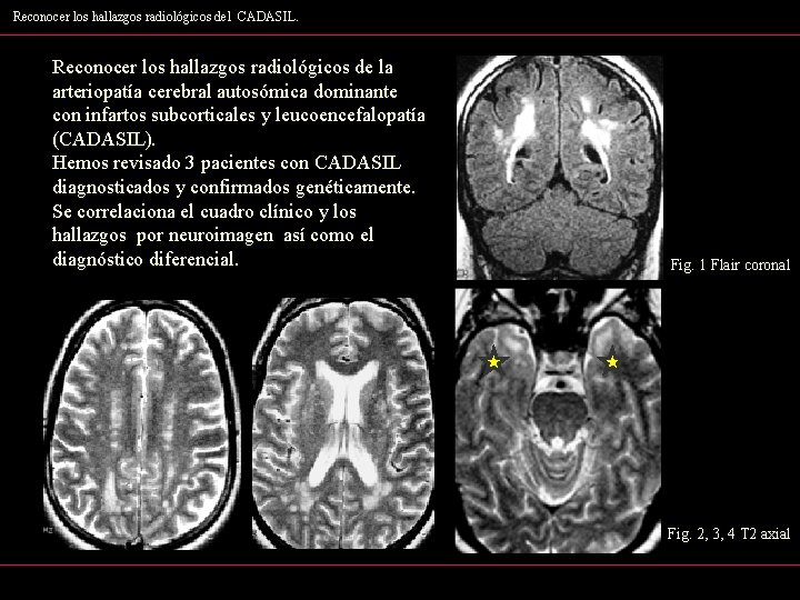 Reconocer los hallazgos radiológicos del CADASIL. Reconocer los hallazgos radiológicos de la arteriopatía cerebral