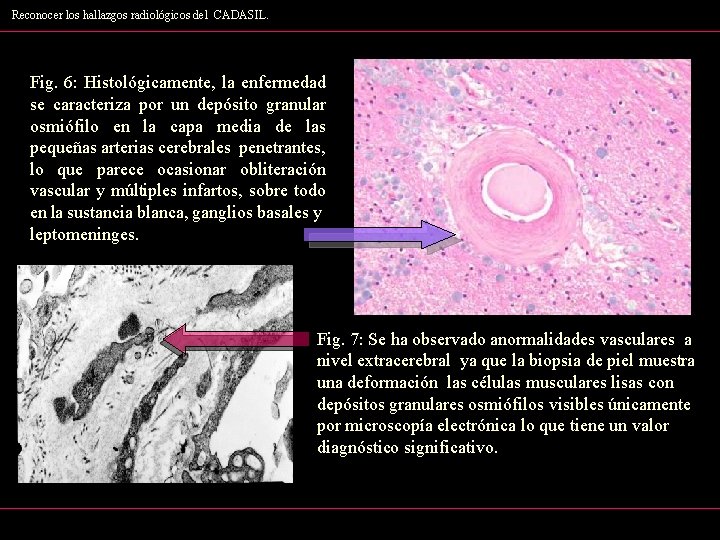 Reconocer los hallazgos radiológicos del CADASIL. Fig. 6: Histológicamente, la enfermedad se caracteriza por