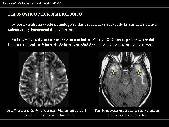 Reconocer los hallazgos radiológicos del CADASIL. DIAGNÓSTICO NEURORADIOLÓGICO Se observa atrofia cerebral, múltiples infartos