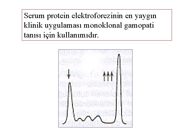 Serum protein elektroforezinin en yaygın klinik uygulaması monoklonal gamopati tanısı için kullanımıdır. 