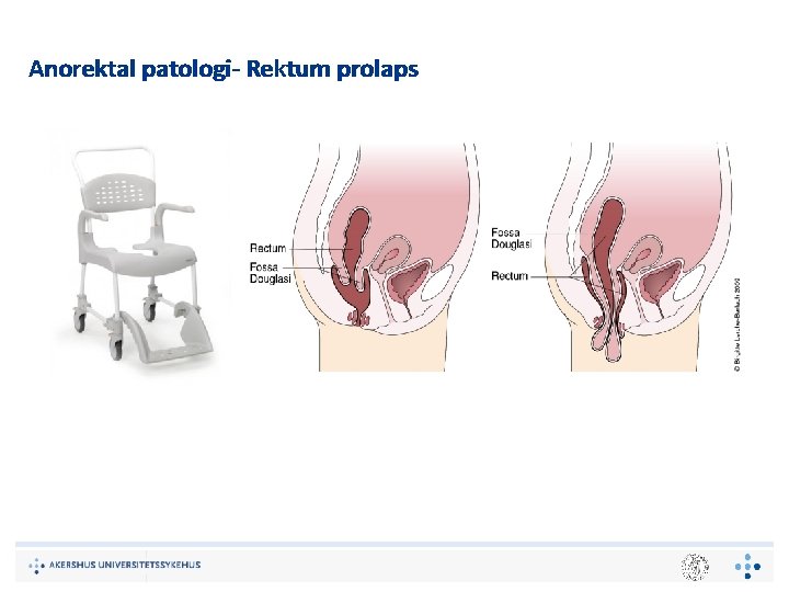 Anorektal patologi‐ Rektum prolaps 