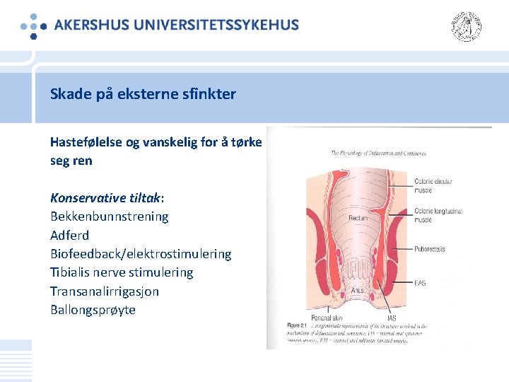 Skade på eksterne sfinkter Hastefølelse og vanskelig for å tørke seg ren Konservative tiltak: