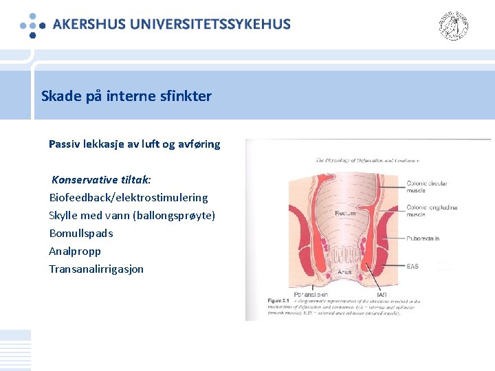 Skade på interne sfinkter Passiv lekkasje av luft og avføring Konservative tiltak: Biofeedback/elektrostimulering Skylle