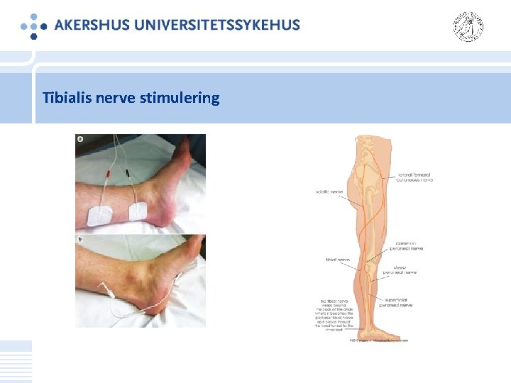 Tibialis nerve stimulering 