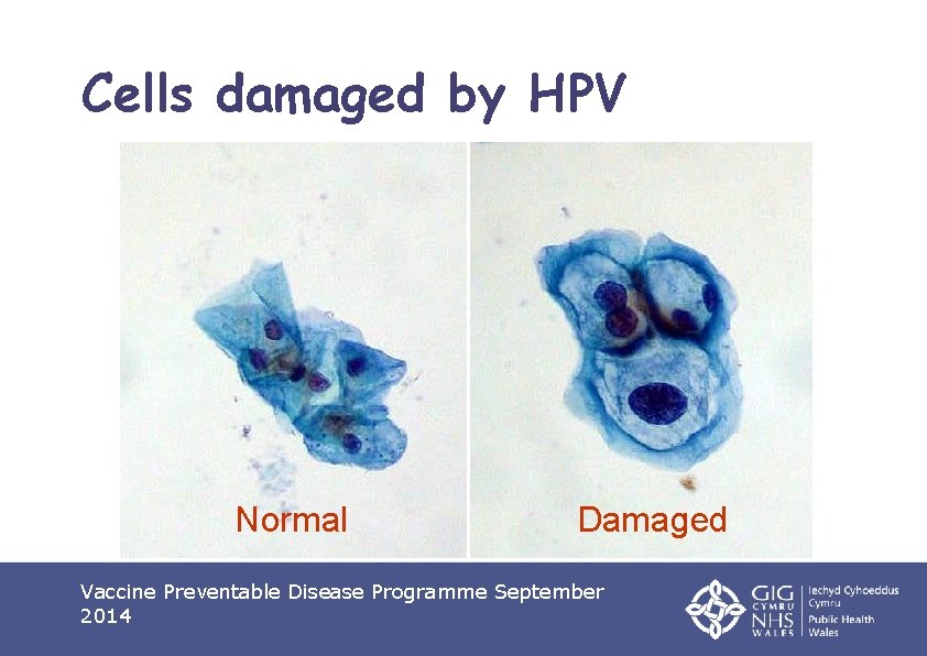 Cells damaged by HPV Normal Damaged Vaccine Preventable Disease Programme September 2014 