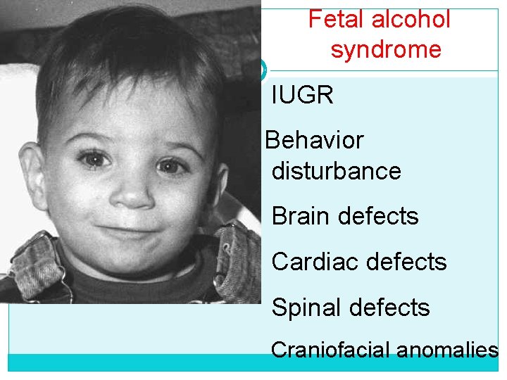 Fetal alcohol syndrome IUGR Behavior disturbance Brain defects Cardiac defects Spinal defects Craniofacial anomalies