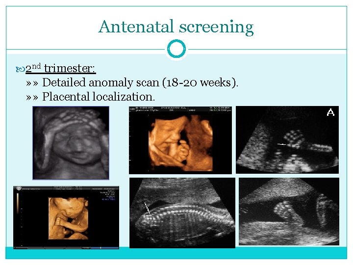 Antenatal screening 2 nd trimester: » » Detailed anomaly scan (18 -20 weeks). »