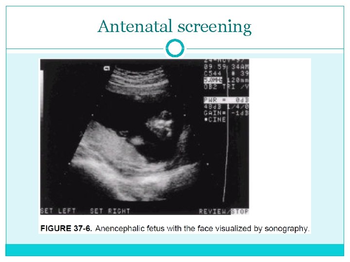 Antenatal screening 