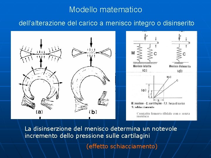 Modello matematico dell’alterazione del carico a menisco integro o disinserito La disinserzione del menisco