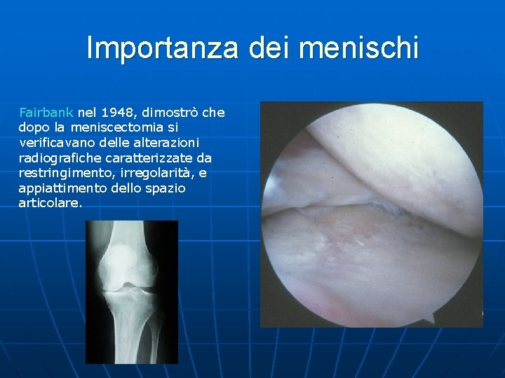 Importanza dei menischi Fairbank nel 1948, dimostrò che dopo la meniscectomia si verificavano delle