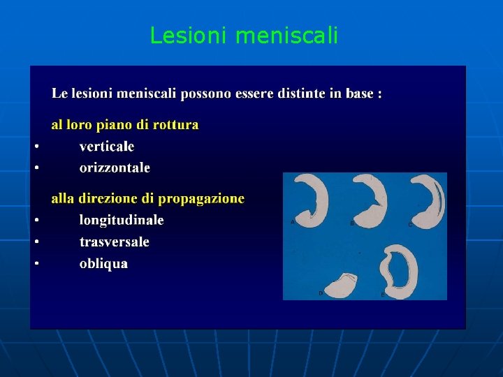 Lesioni meniscali 