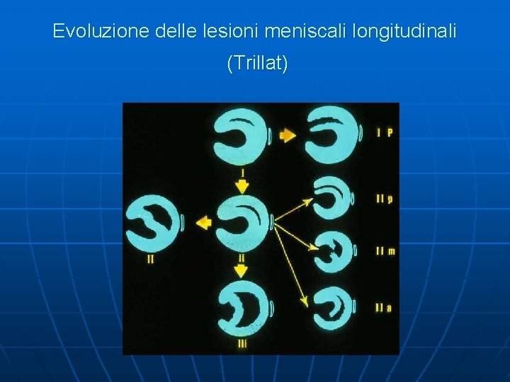 Evoluzione delle lesioni meniscali longitudinali (Trillat) 