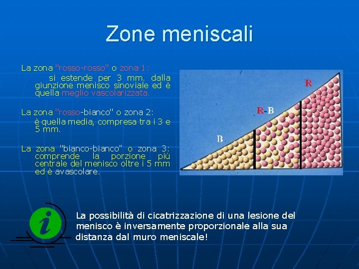 Zone meniscali La zona "rosso-rosso" o zona 1: si estende per 3 mm. dalla