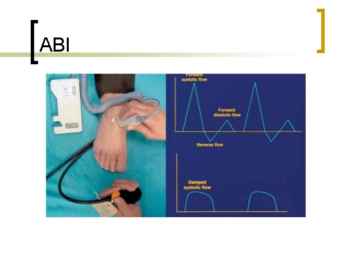 ABI 