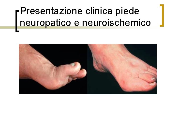 Presentazione clinica piede neuropatico e neuroischemico 