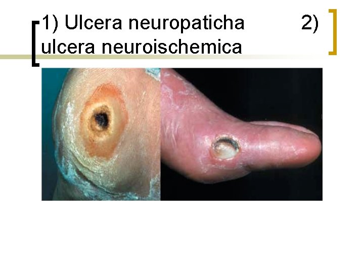 1) Ulcera neuropaticha 2) ulcera neuroischemica 