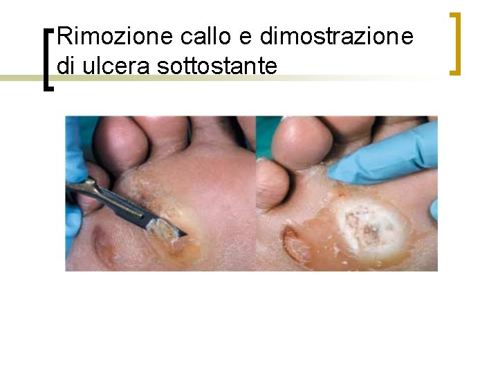 Rimozione callo e dimostrazione di ulcera sottostante 