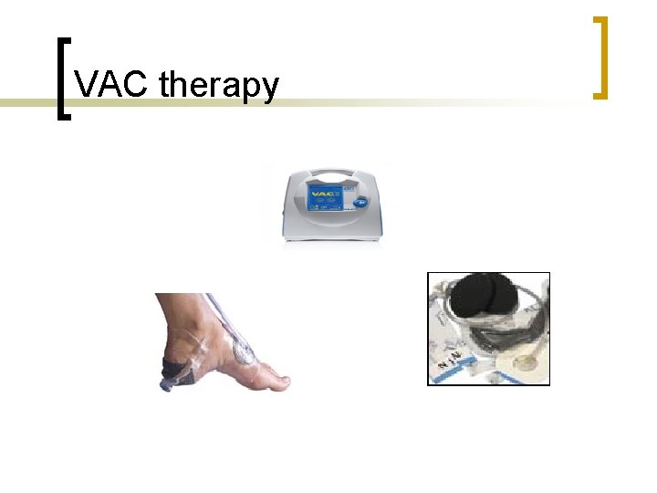 VAC therapy 