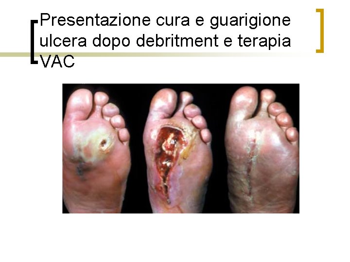 Presentazione cura e guarigione ulcera dopo debritment e terapia VAC 