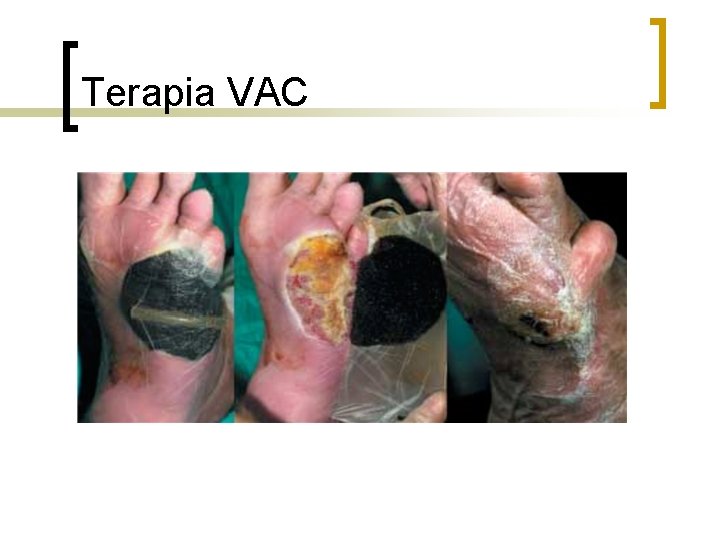 Terapia VAC 