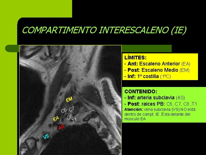 COMPARTIMENTO INTERESCALENO (IE) LÍMITES: - Ant: Escaleno Anterior (EA) - Post: Post Escaleno Medio