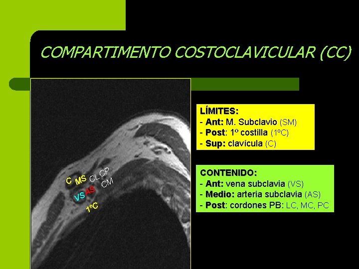 COMPARTIMENTO COSTOCLAVICULAR (CC) LÍMITES: - Ant: M. Subclavio (SM) - Post: Post 1º costilla