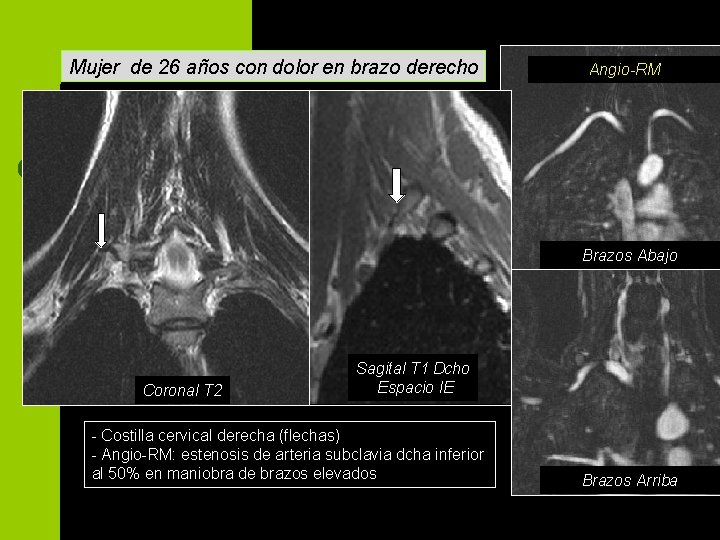 Mujer de 26 años con dolor en brazo derecho Angio-RM Brazos Abajo Coronal T