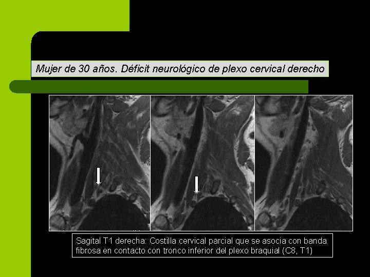 Mujer de 30 años. Déficit neurológico de plexo cervical derecho Sagital T 1 derecha: