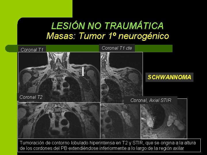 LESIÓN NO TRAUMÁTICA Masas: Tumor 1º neurogénico Coronal T 1 cte SCHWANNOMA Coronal T