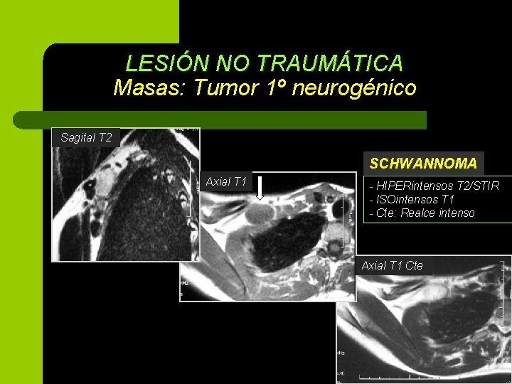 LESIÓN NO TRAUMÁTICA Masas: Tumor 1º neurogénico Sagital T 2 SCHWANNOMA Axial T 1